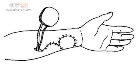 前臂外侧皮神经营养血管远端蒂皮瓣在手部创伤修复中的应用